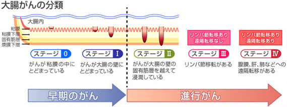 大腸がんの分類