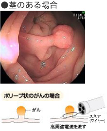 茎のある場合