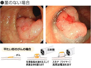 茎のない場合
